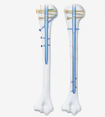 compare product Humerus Multi-Lock Intramedullary Nail